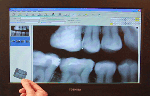 Digital Radiographs | GS Dental | Dr. Giombolini and Dr. Sill | Albuquerque, NM 87109 Digital Radiographs | GS Dental | Dr. Giombolini and Dr. Sill | Albuquerque, NM 87109