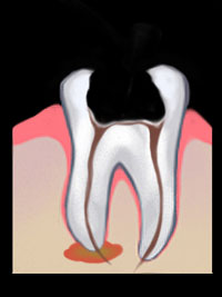 Root Canal | GS Dental | Dr. Giombolini and Dr. Sill | Albuquerque, NM 87109