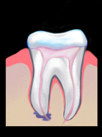 Root Canal | GS Dental | Dr. Giombolini and Dr. Sill | Albuquerque, NM 87109