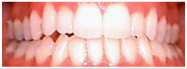 White Fillings | GS Dental | Dr. Giombolini and Dr. Sill | Albuquerque, NM 87109